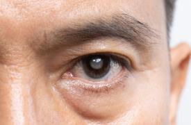 Μάτια: Επτά μέτρα πρόληψης του καταρράκτη