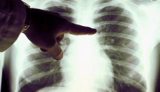 Καρκίνος πνεύμονα: Ο προσυμπτωματικός έλεγχος σώζει ζωές