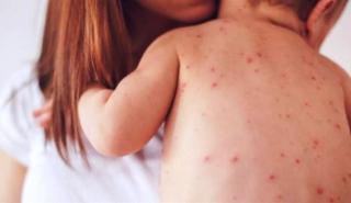ΠΟΥ: Ραγδαία άνοδος των κρουσμάτων ιλαράς στην Ευρώπη