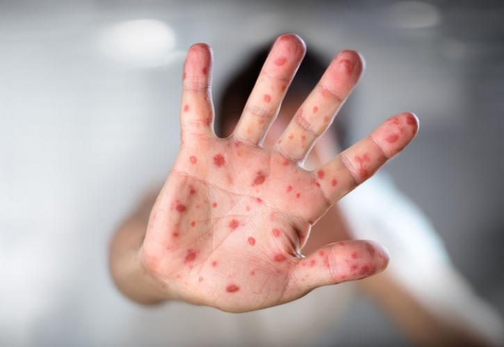 ΕΚΠΑ για ιλαρά: Η πιο μολυσματική ασθένεια που έχει γνωρίσει η επιστήμη 